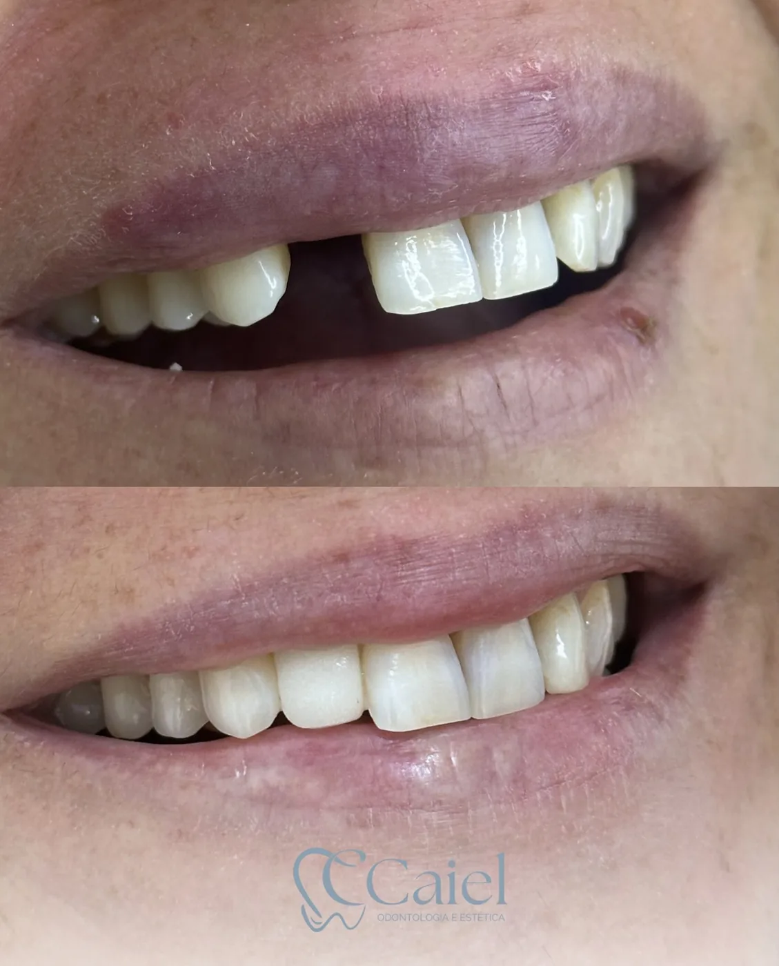 Caso real de facetas em resina na Clínica Caíel — antes com espaço entre os dentes, depois com sorriso alinhado e branco natural
